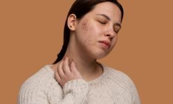 when should you do something about acne scars