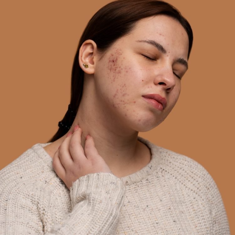 when should you do something about acne scars