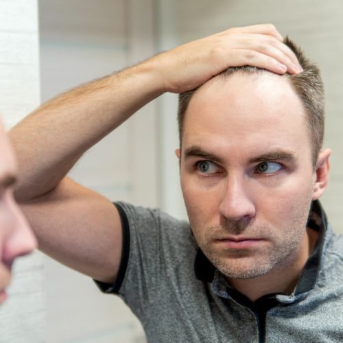 high hairline