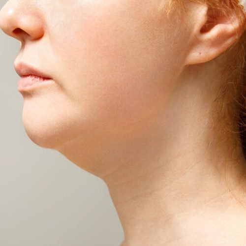 weak chin