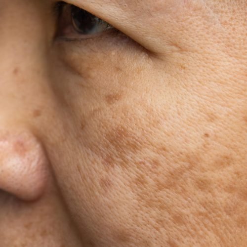 pigmentation