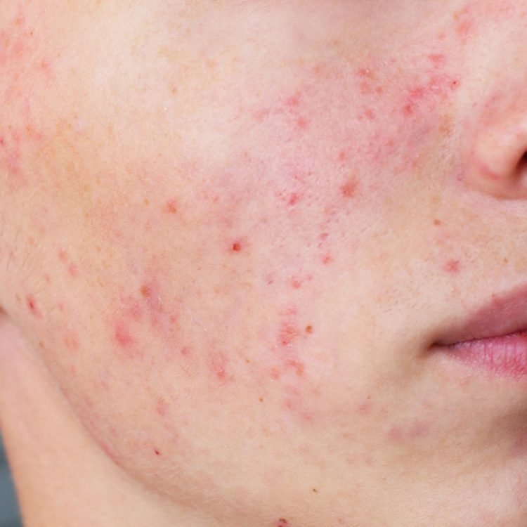 does acne get worse if left untreated
