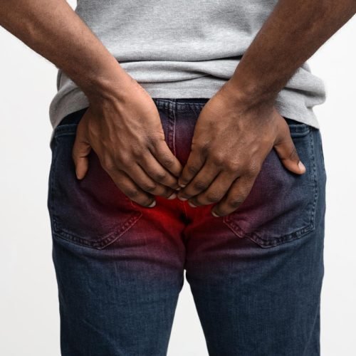 haemorrhoids