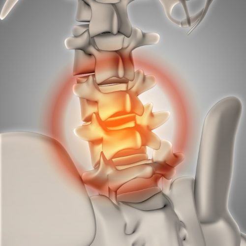 slipped disc