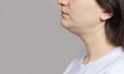 can a double chin be prevented
