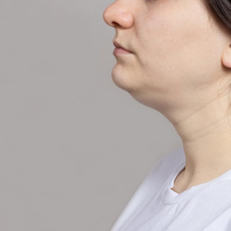 can a double chin be prevented