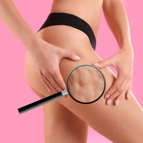 cellulite