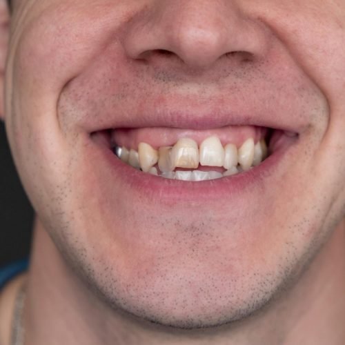 crooked teeth