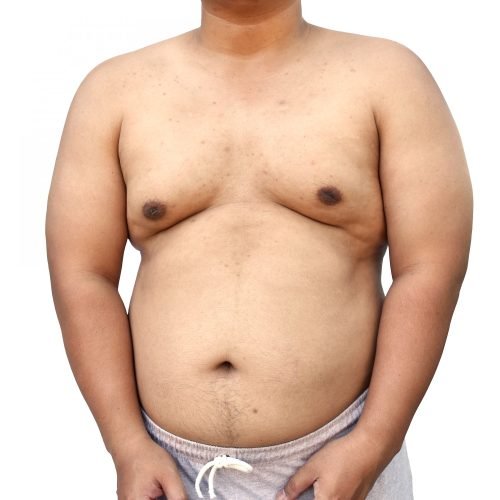 enlarged male chest