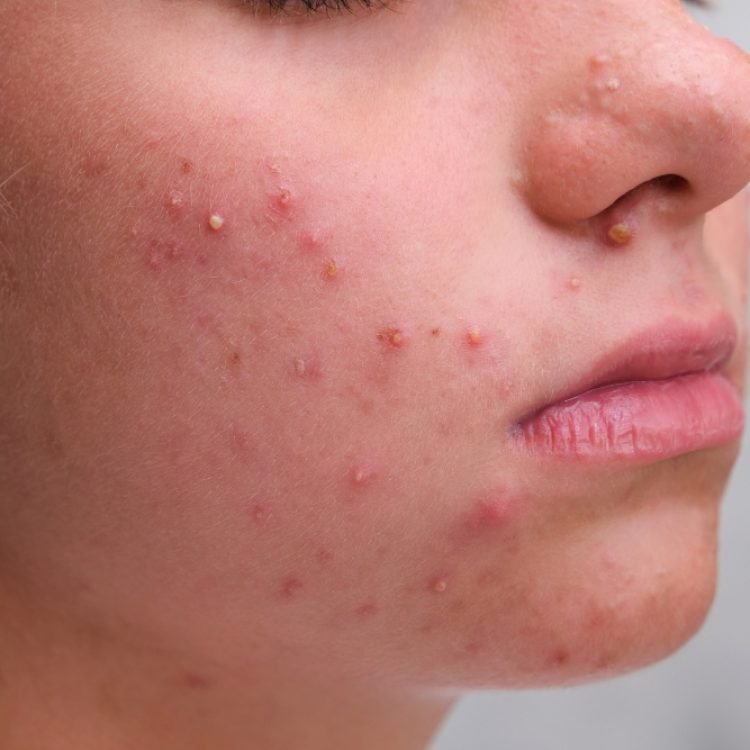 do hormones cause acne