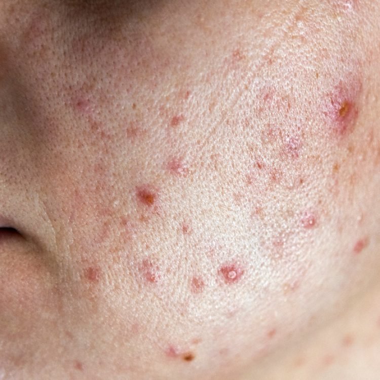can acne be prevented