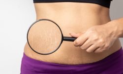 do stretch marks decrease skin elasticity