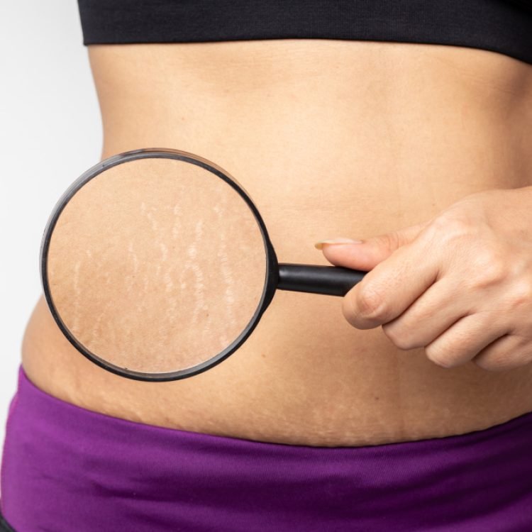 do stretch marks decrease skin elasticity