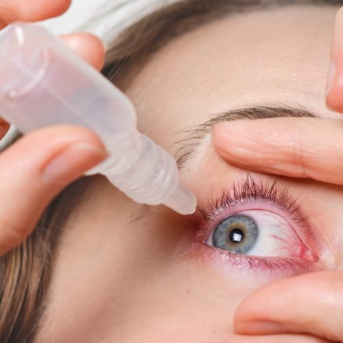 dry eyes